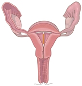 Внутриматочная контрацепция